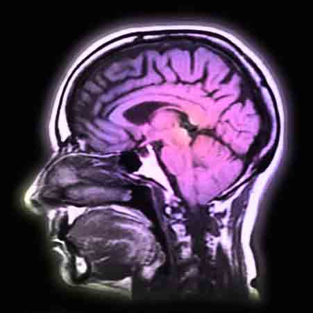 MRI of Human Head